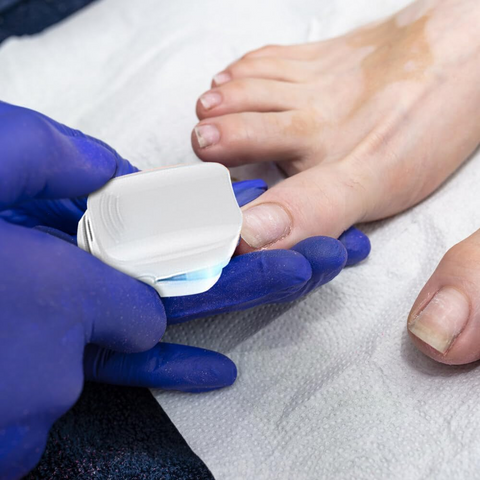 Hatmeo Portable UV Light Therapy Lamp Against Onychomycosis
