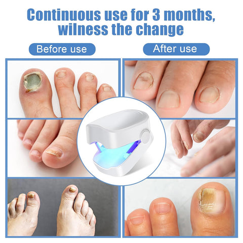 Hatmeo Portable UV Light Therapy Lamp Against Onychomycosis