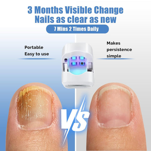 Hatmeo Portable UV Light Therapy Lamp Against Onychomycosis