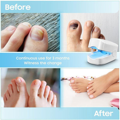 Hatmeo Portable UV Light Therapy Lamp Against Onychomycosis